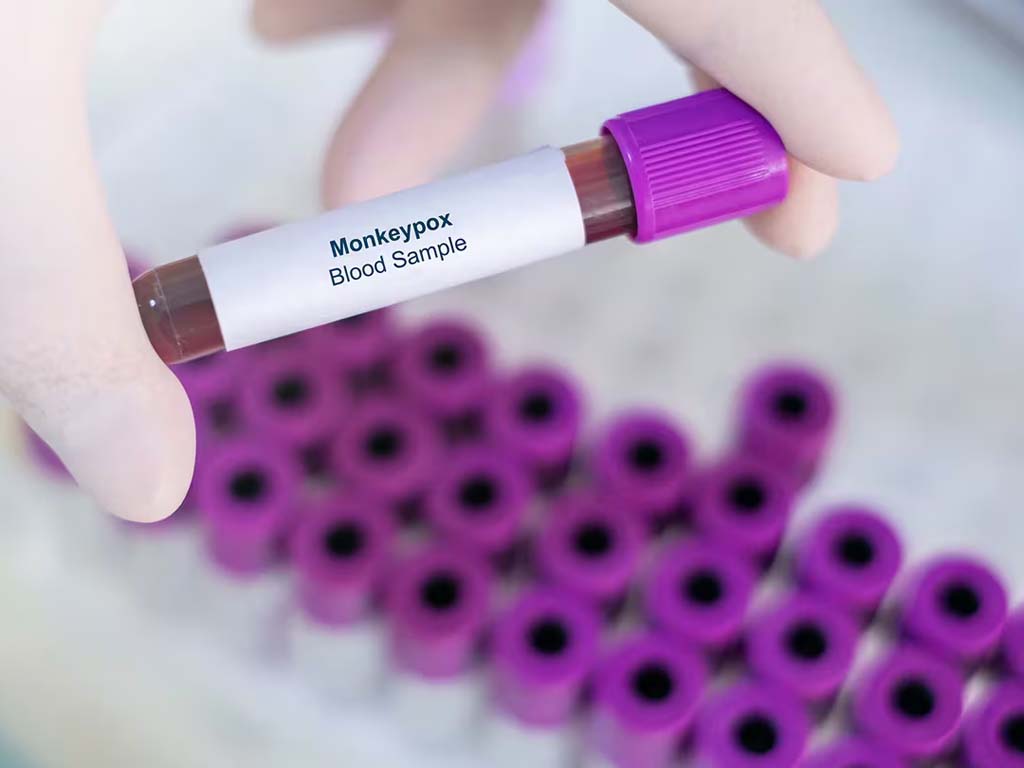 Sudáfrica alerta tras casos de Mpox