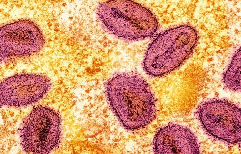 Una micrografía electrónica de transmisión coloreada sin fecha de partículas del virus mpox (rosa) encontradas dentro de una célula infectada (amarilla) Foto: archivos de Reuters