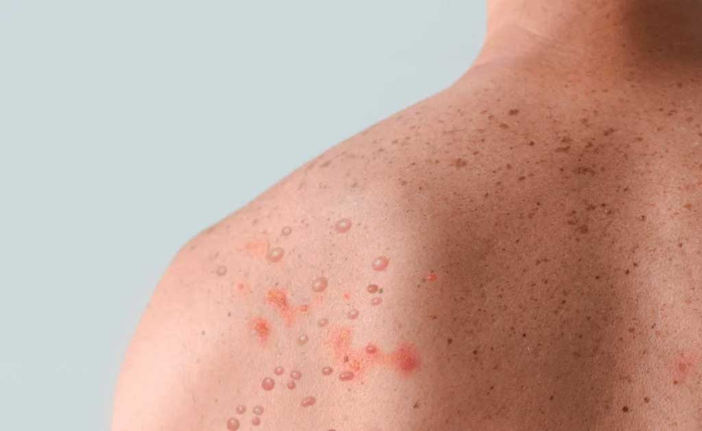 España adoptará nuevas medidas contra viruela mpox